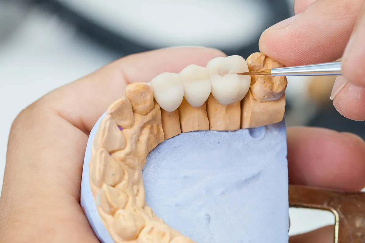 Dental Bridges in Houston, TX