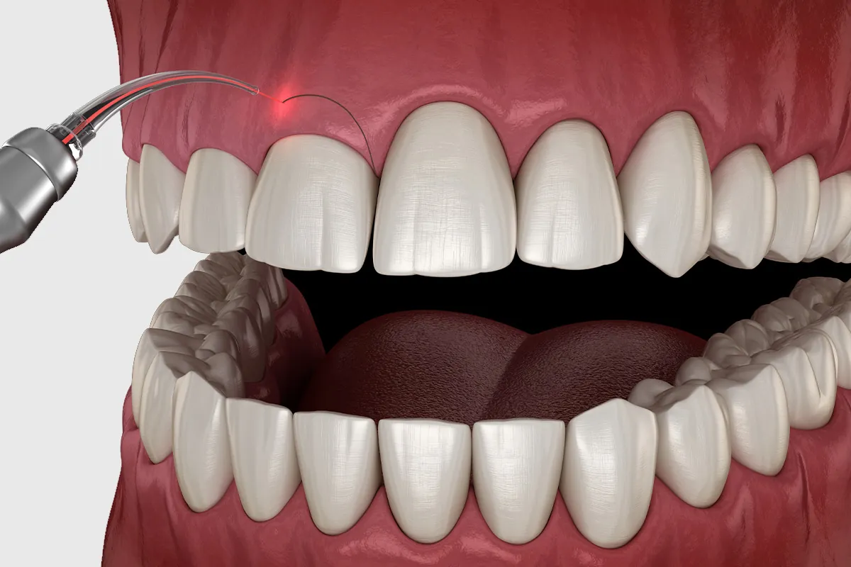 Crown Lengthening at Lava Dental