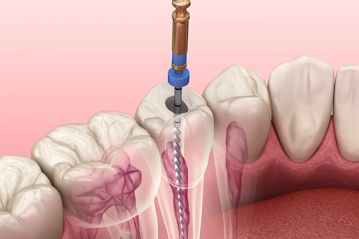 Root Canal at Lava Dental