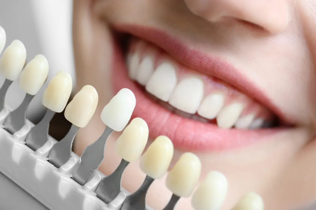 Teeth Whitening at Lava Dental