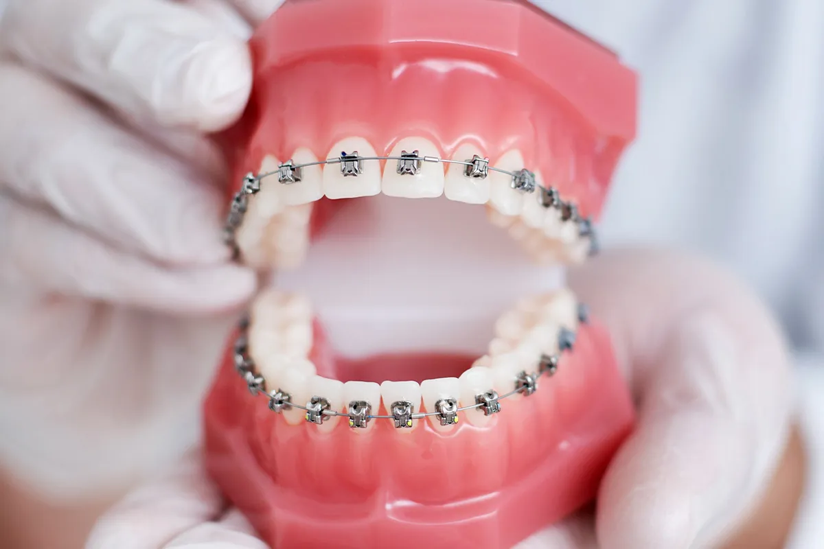 Orthodontics at Lava Dental