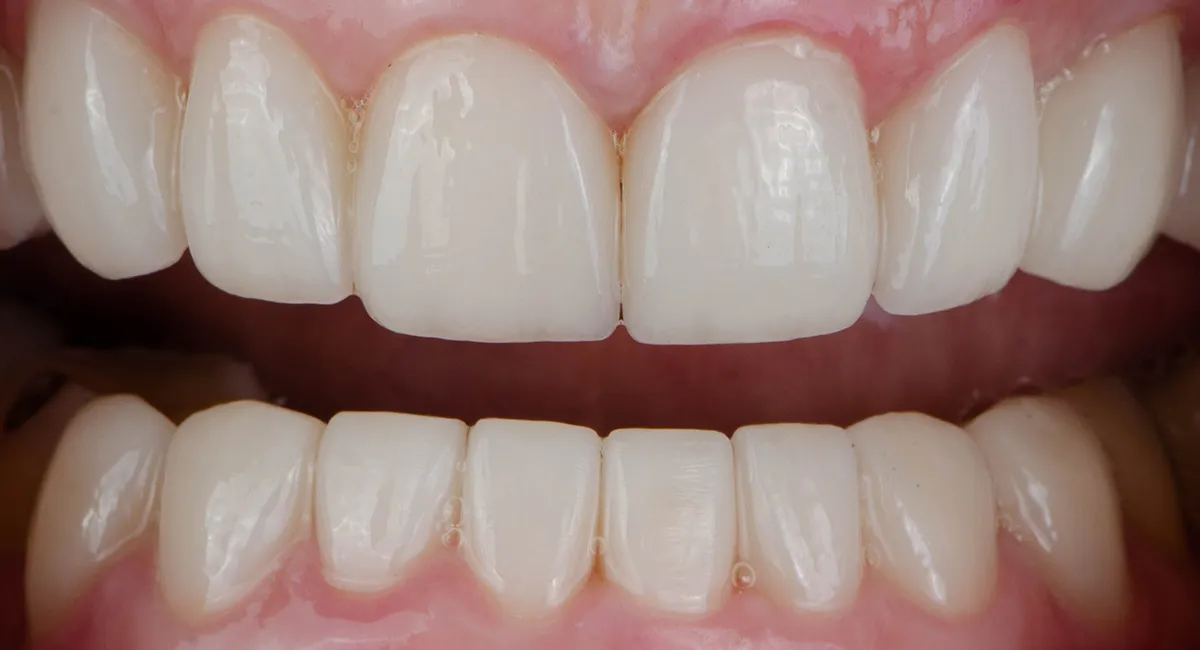 After — Smile makeover