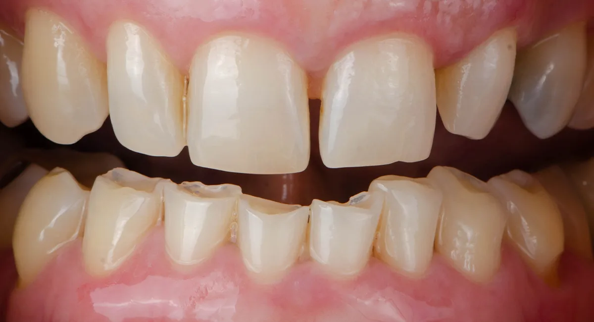 Before — Smile makeover