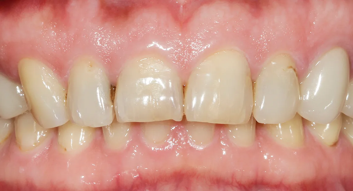 Before — Smile makeover