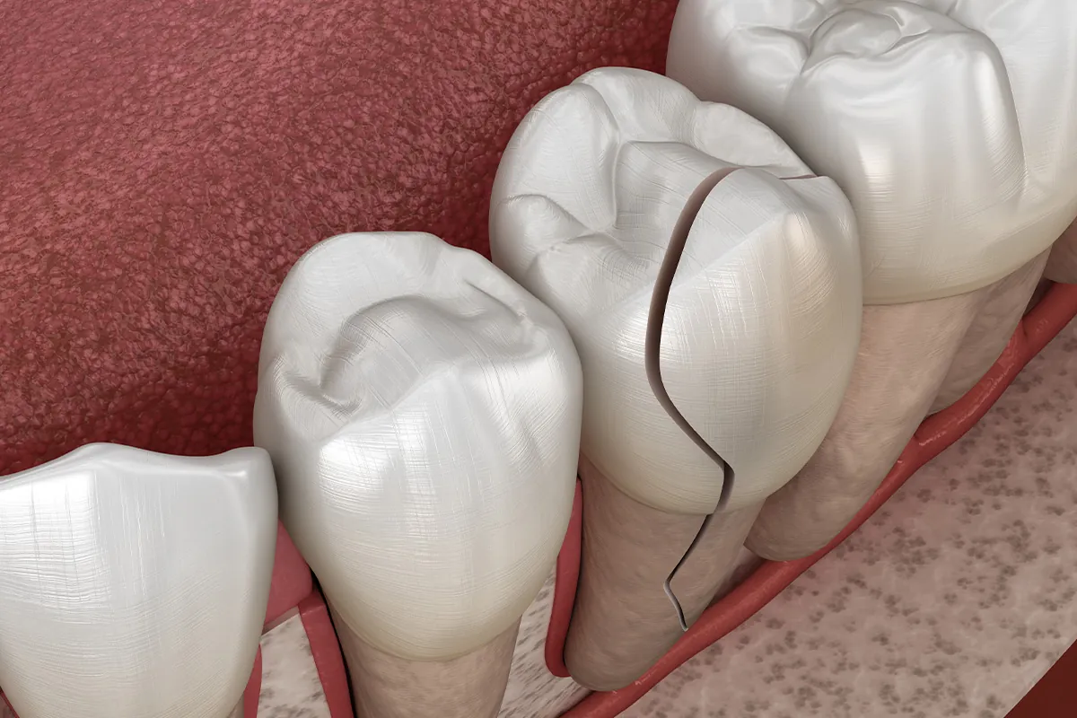 What Should I Do If I Chip My Tooth