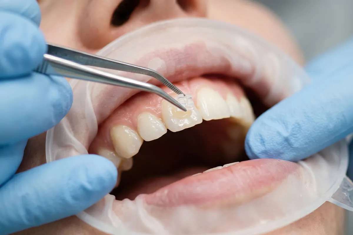 How Can I Fix a Chipped Tooth?