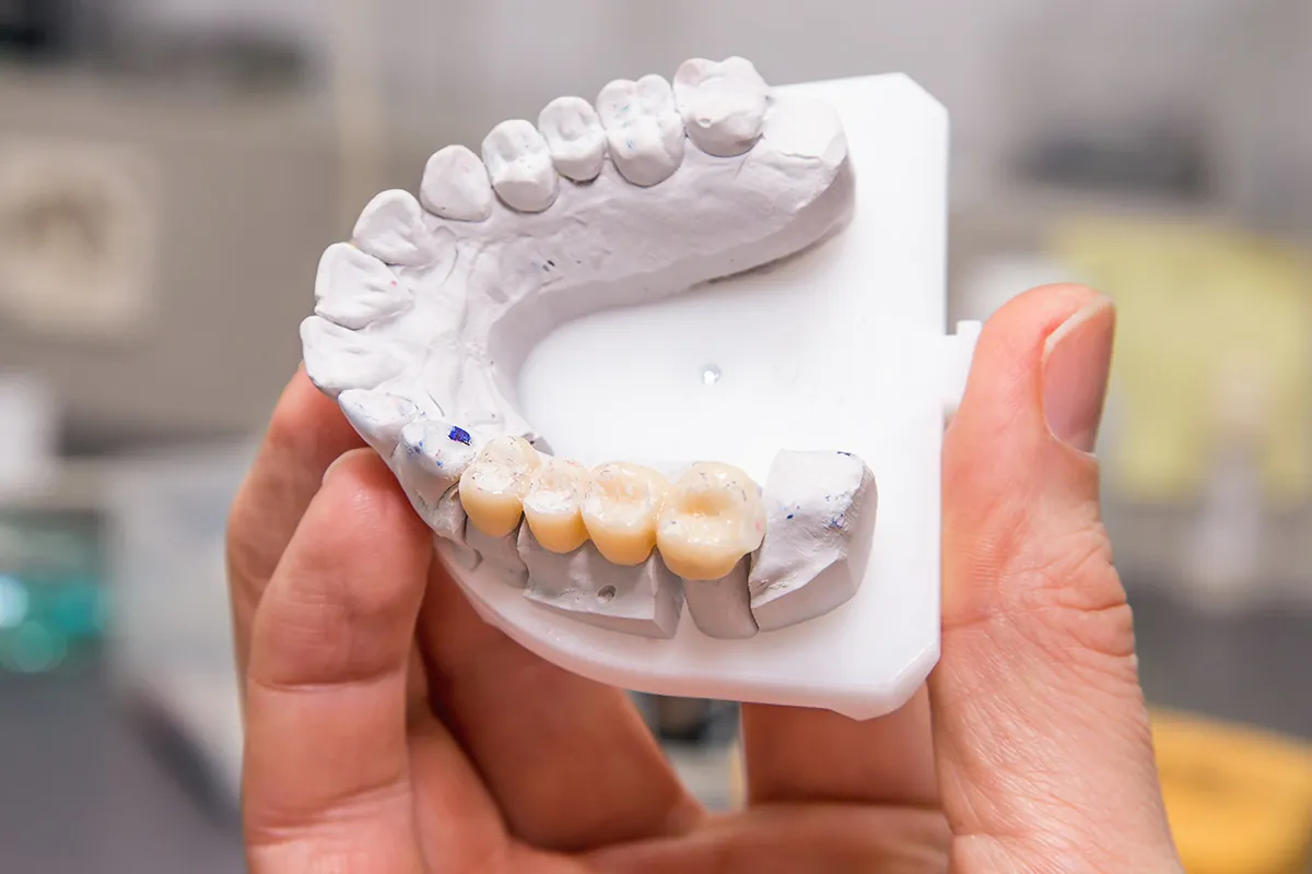 Dental Bridges at Lava Dental