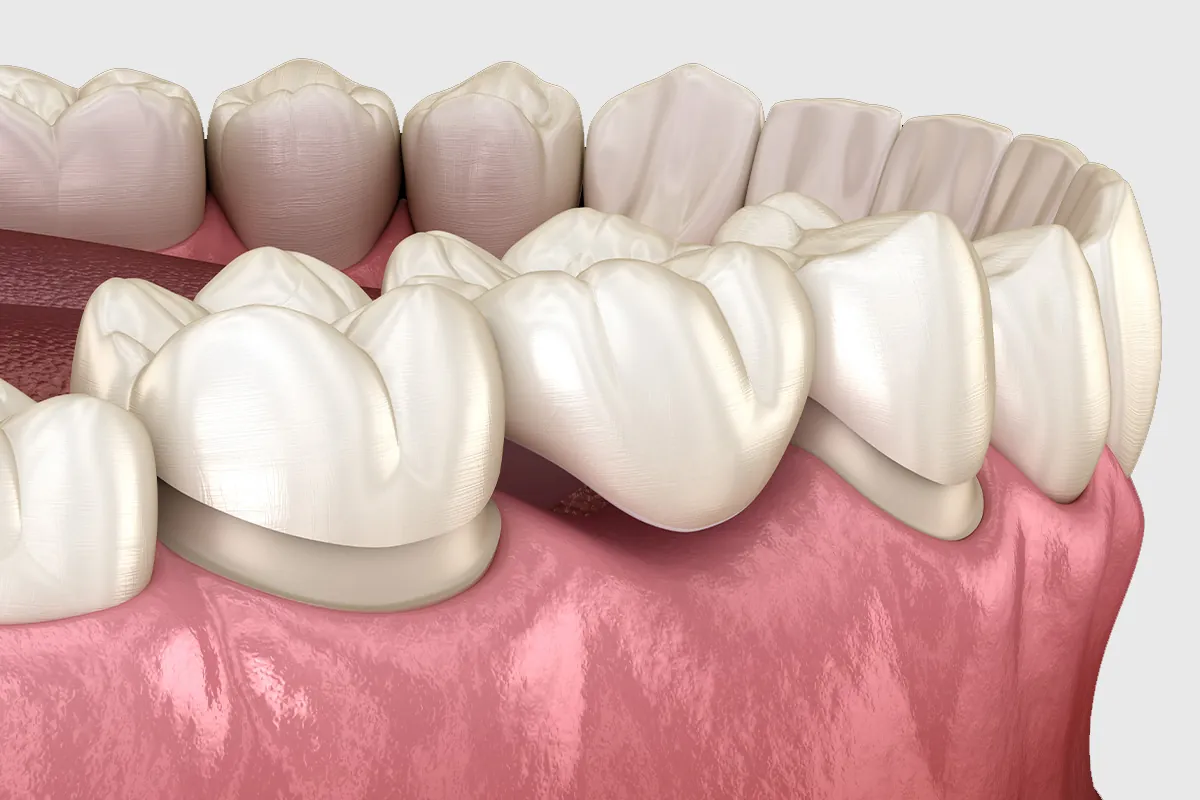 Revamp Your Smile: Choosing Between Implants and Bridges