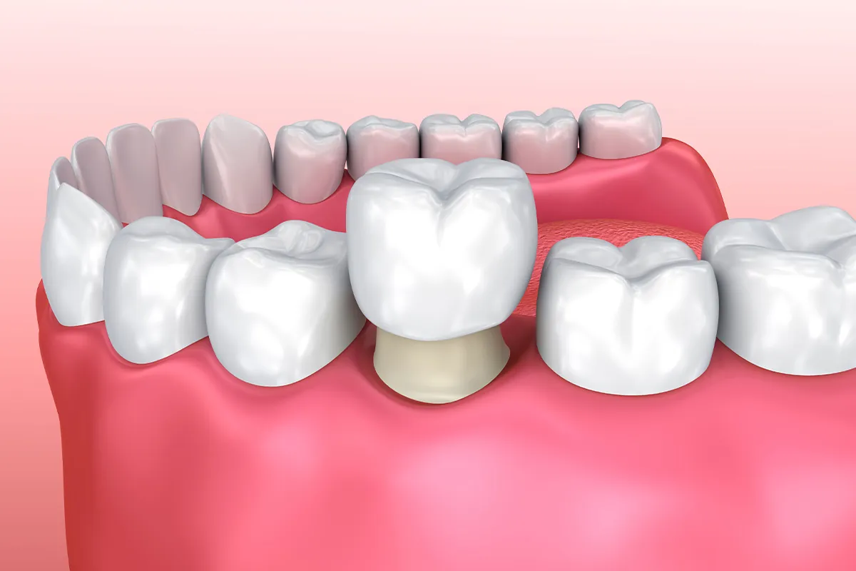 Restorative Dentistry at Lava Dental
