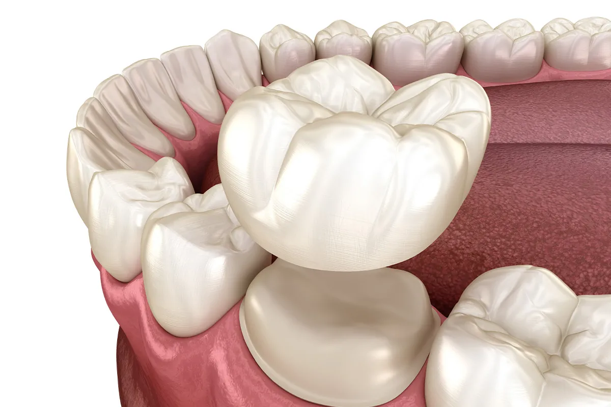 What Are the Pros and Cons of Dental Crowns?