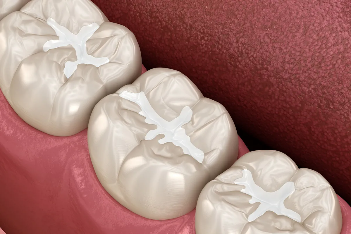 Tooth-Colored Fillings at Lava Dental