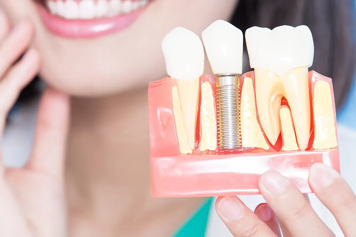 Dental Implants: The Modern Solution for a Complete and Confident Smile