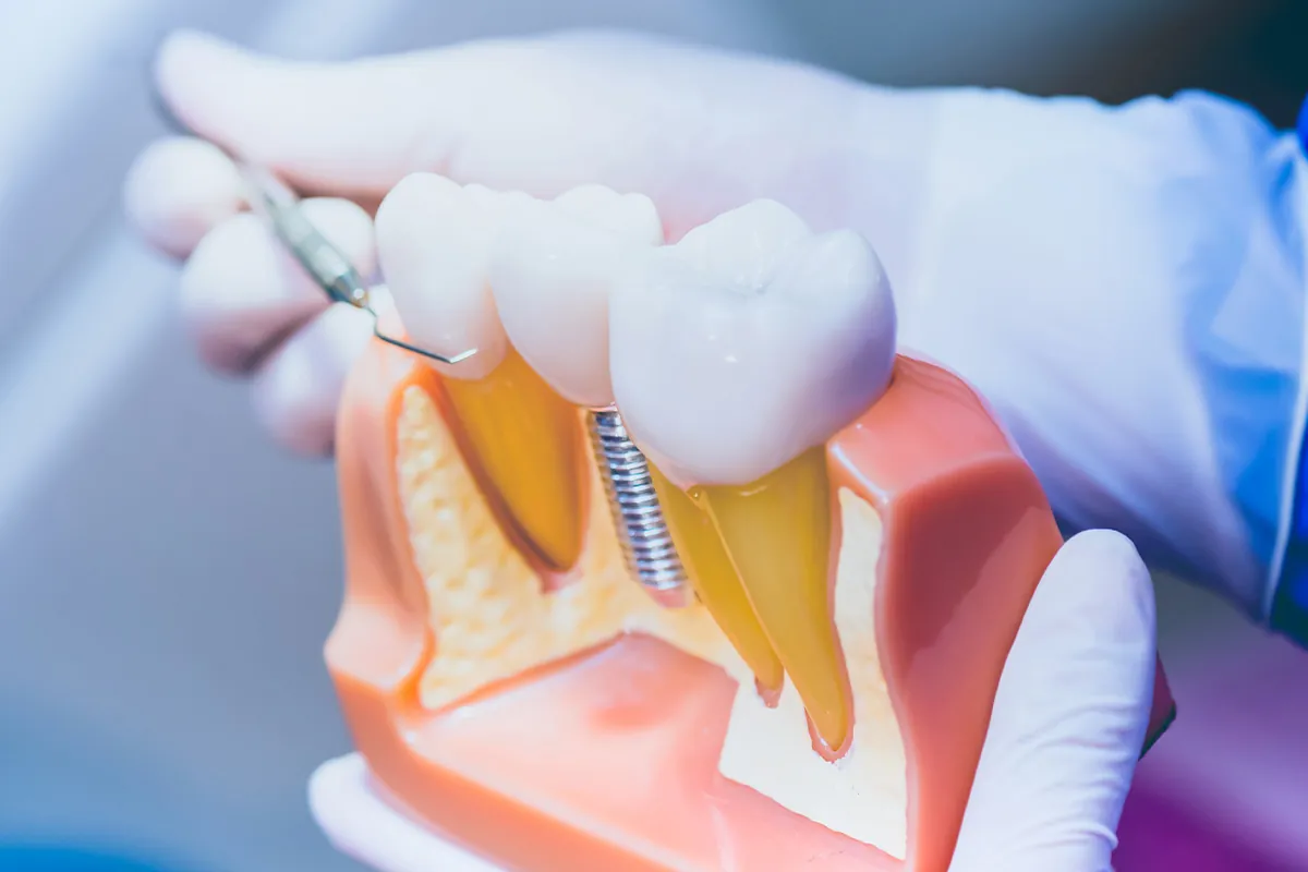 5 Signs You Need a Dental Implant