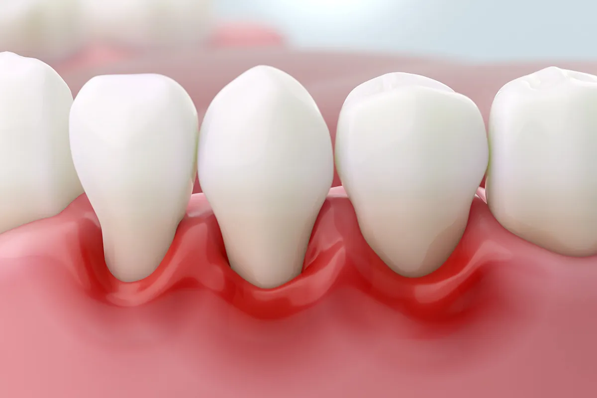 Gum Disease: The Silent Killer That Can Damage Your Health and Appearance