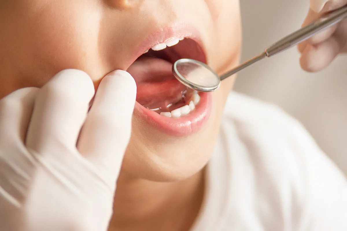 Fluoride Treatments at Lava Dental