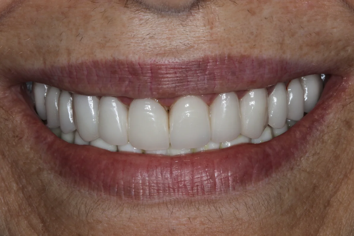 After — real smile transformation at Lava Dental
