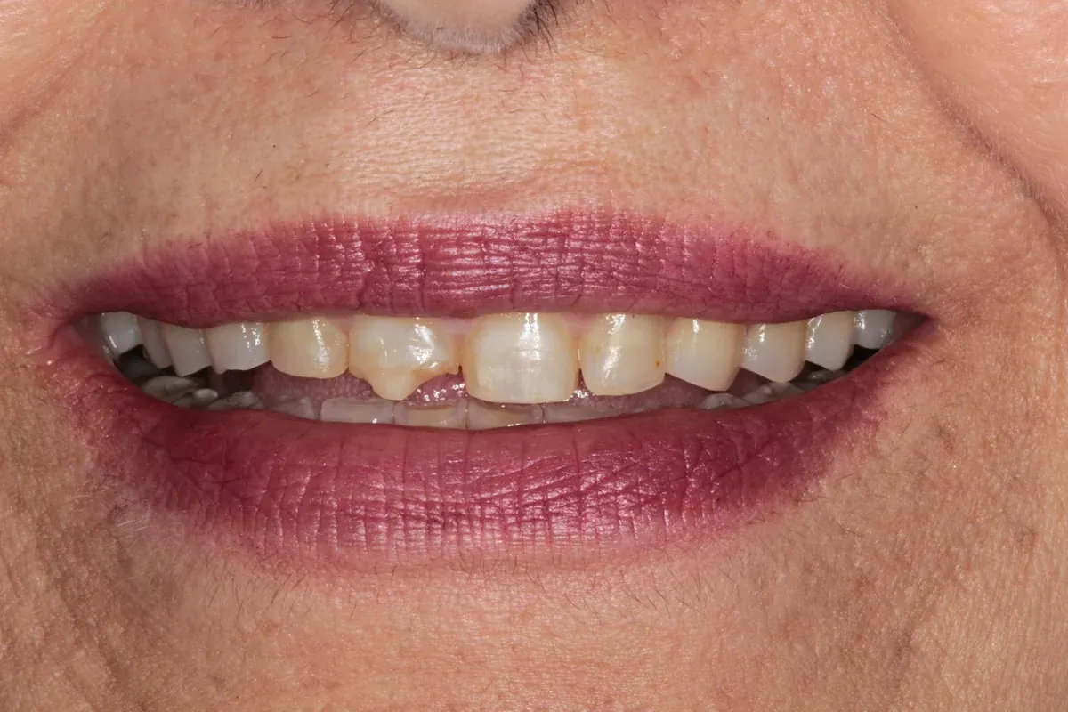 Before — real smile transformation at Lava Dental