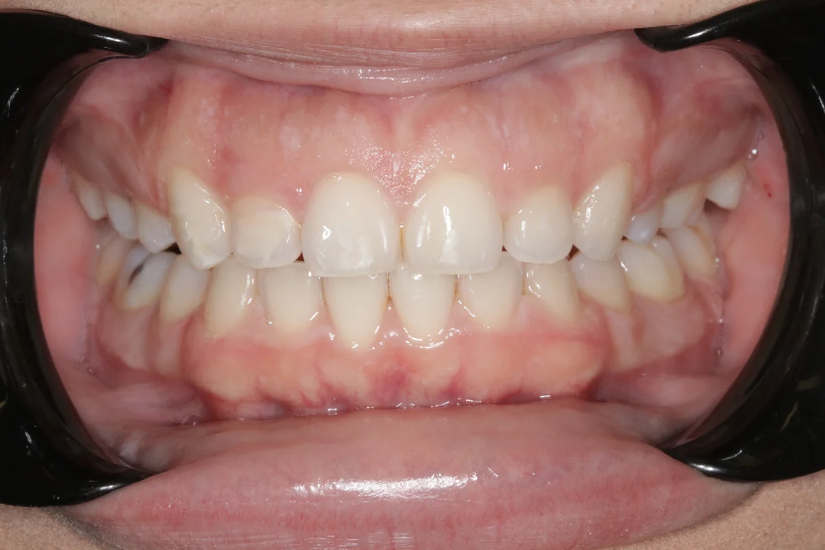 After — real smile transformation at Lava Dental