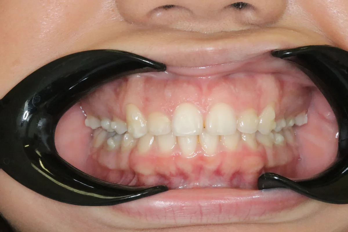 Before — real smile transformation at Lava Dental