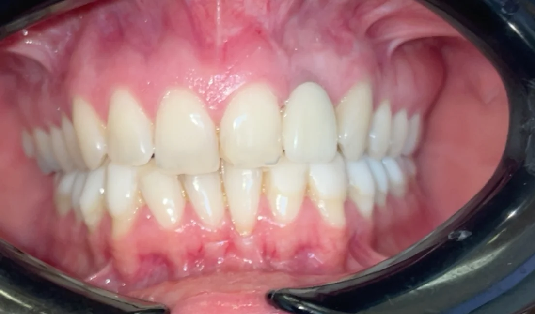 After — real smile transformation at Lava Dental