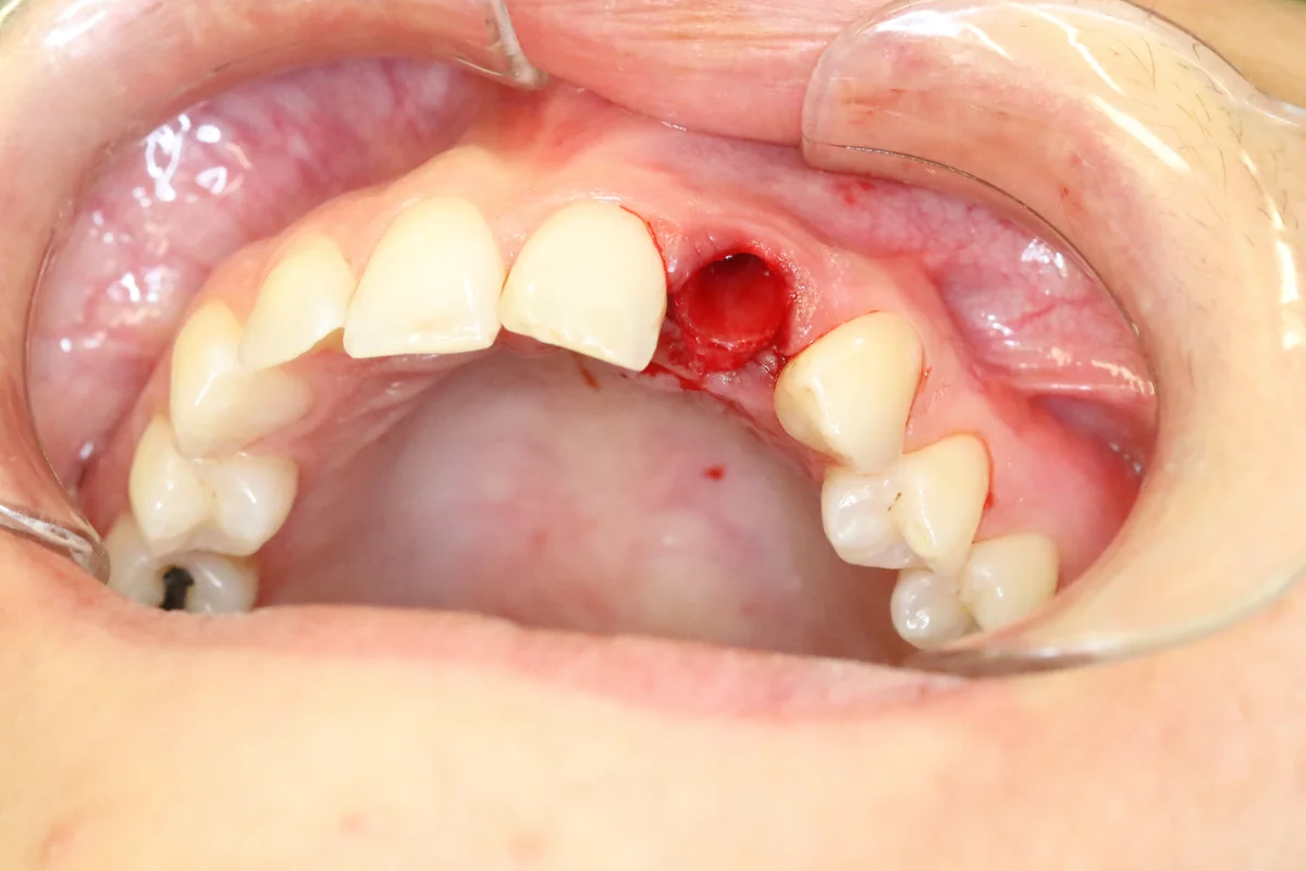 Before — real smile transformation at Lava Dental