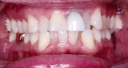 Before — real smile transformation at Lava Dental