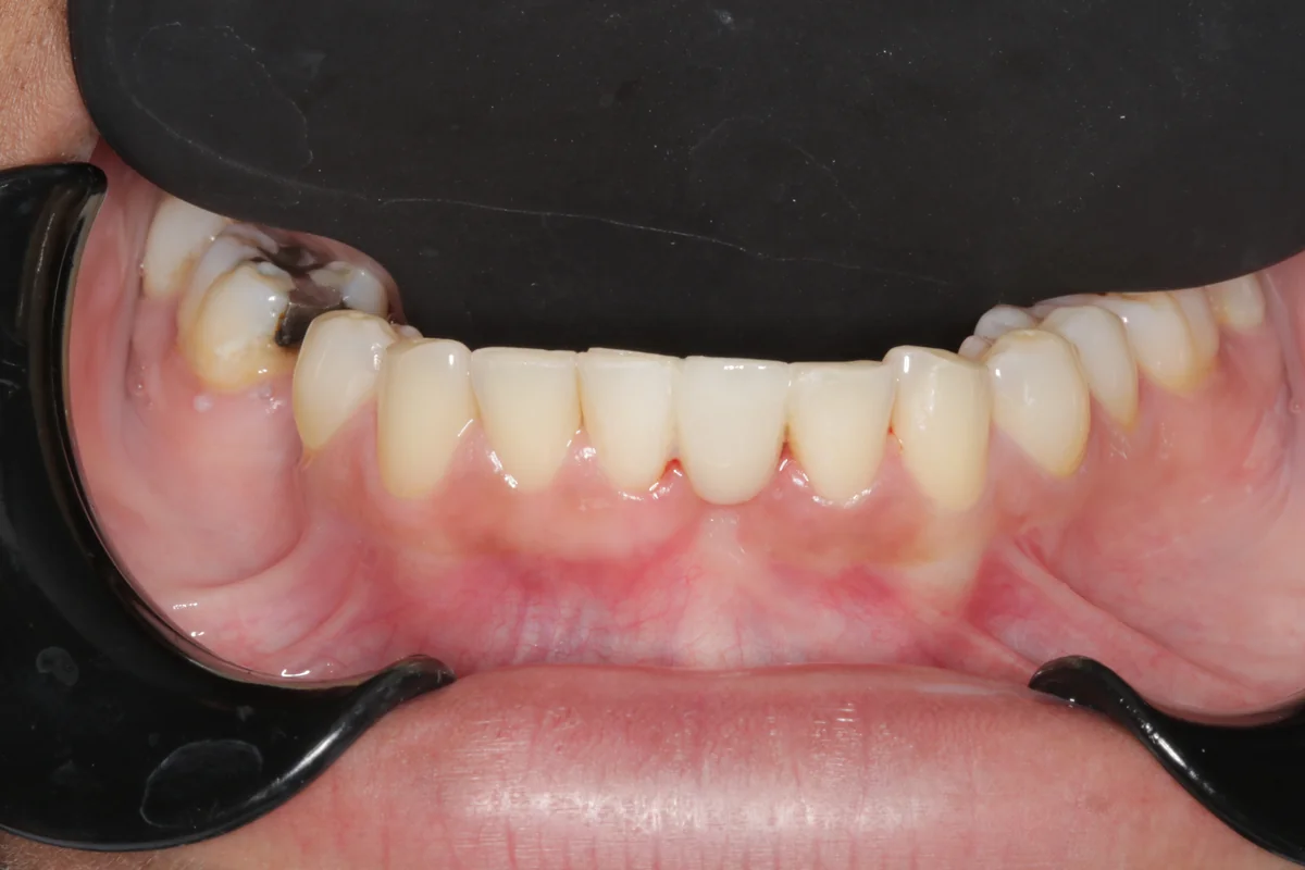 After — real smile transformation at Lava Dental
