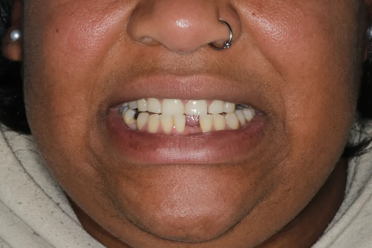 Before — real smile transformation at Lava Dental