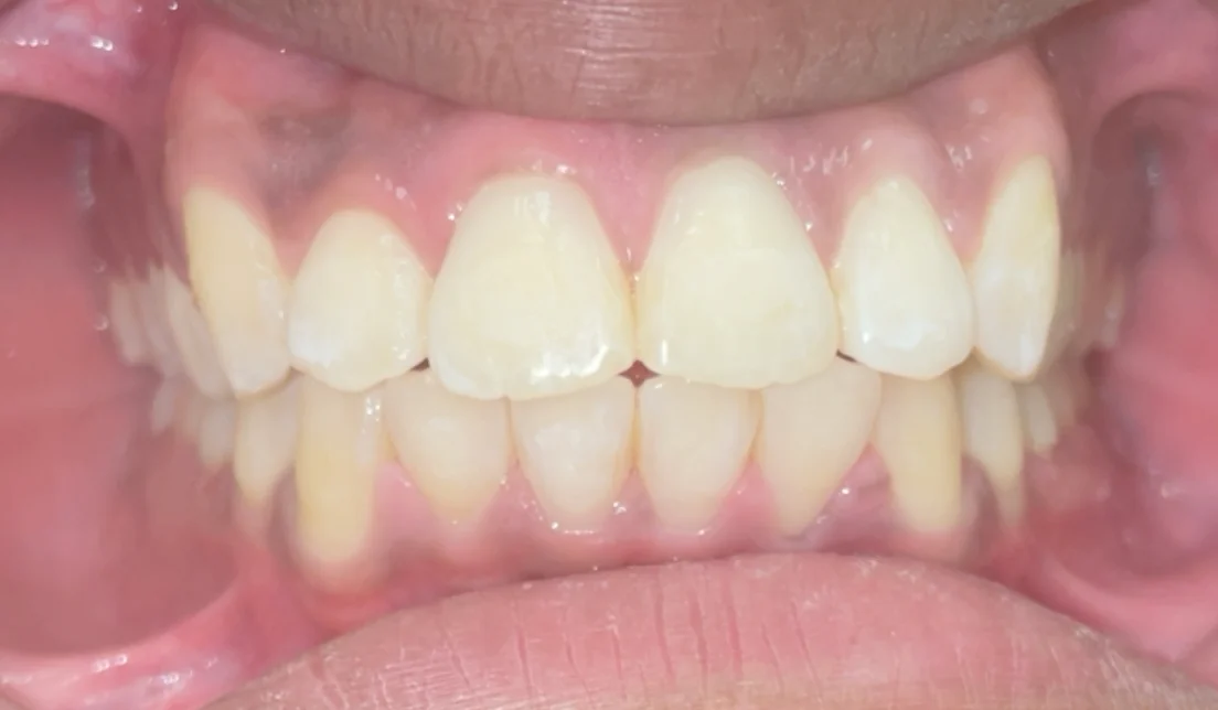 After — real smile transformation at Lava Dental