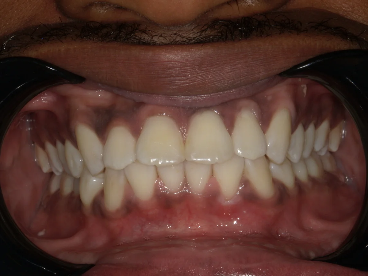 Before — real smile transformation at Lava Dental