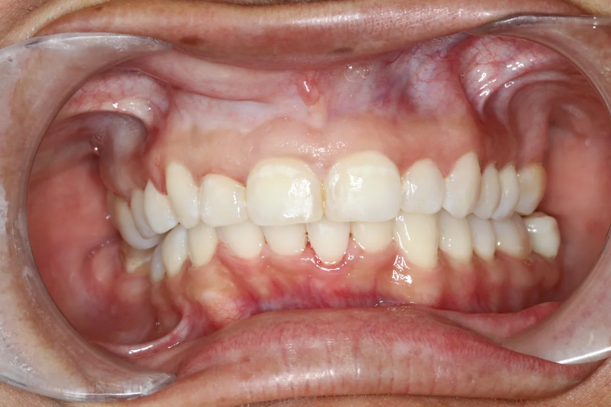 After — real smile transformation at Lava Dental