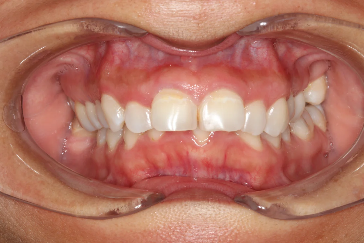 Before — real smile transformation at Lava Dental