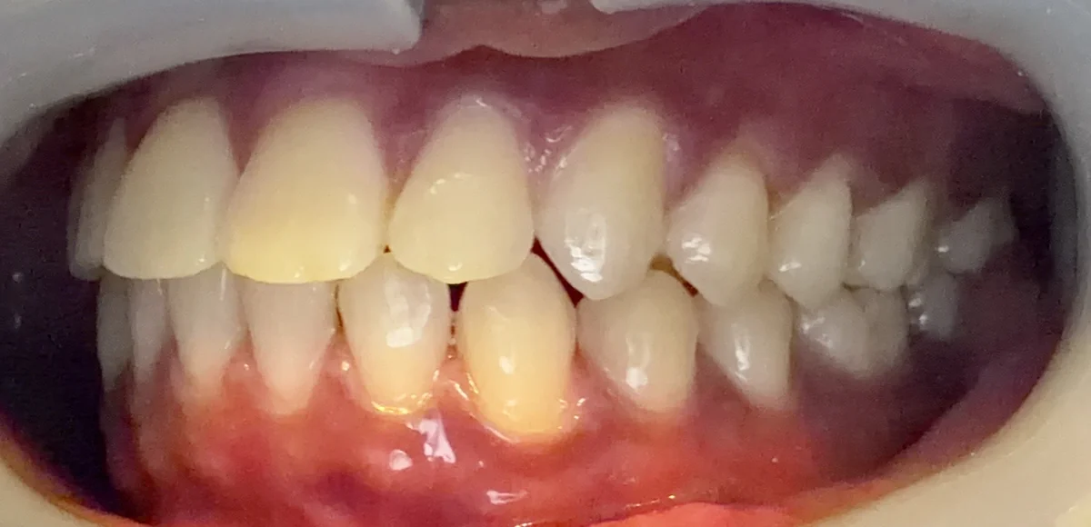 After — real smile transformation at Lava Dental