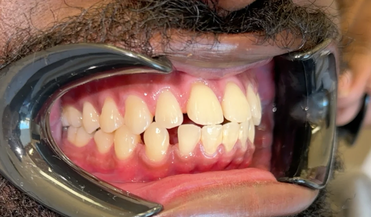 Before — real smile transformation at Lava Dental