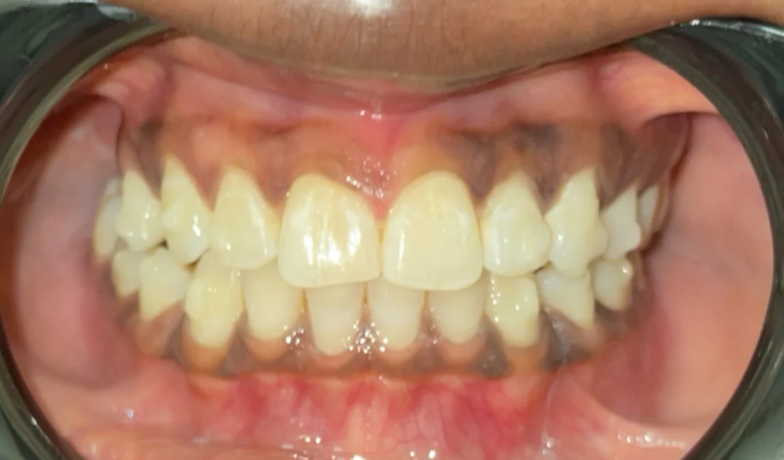 After — real smile transformation at Lava Dental
