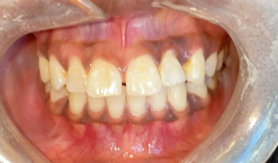 Before — real smile transformation at Lava Dental