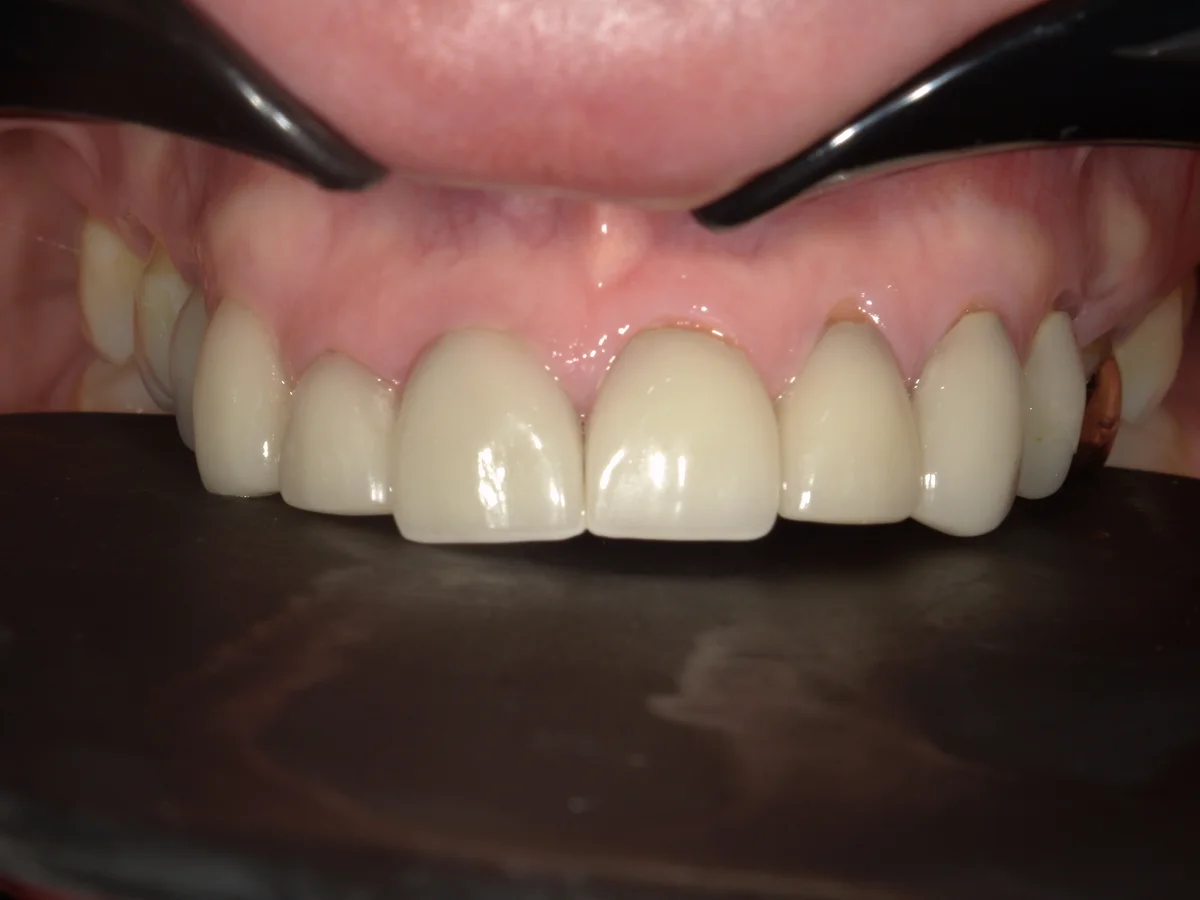 Before — real smile transformation at Lava Dental