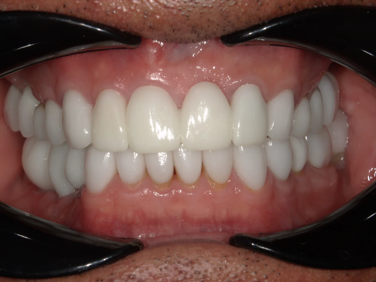 After — real smile transformation at Lava Dental