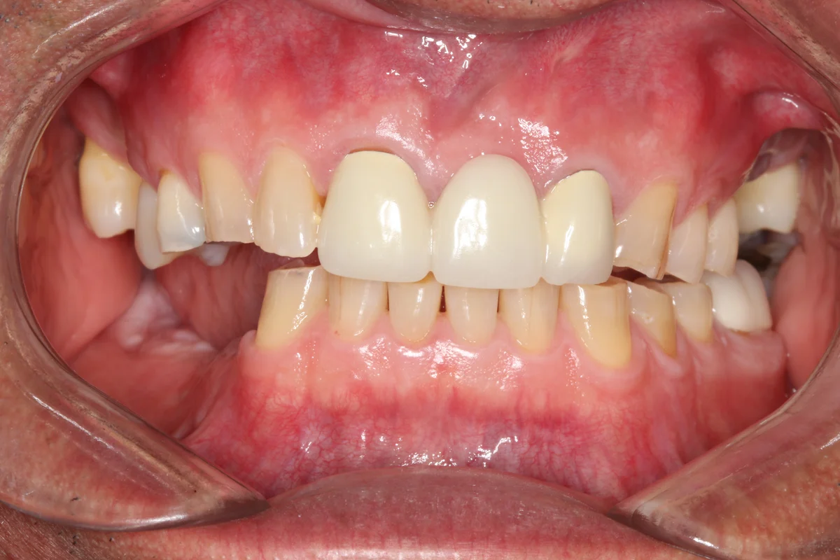 Before — real smile transformation at Lava Dental