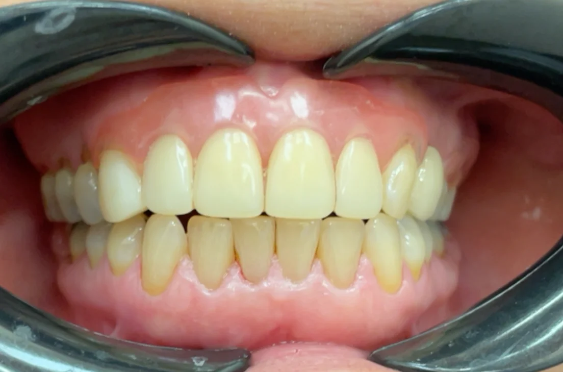 After — real smile transformation at Lava Dental