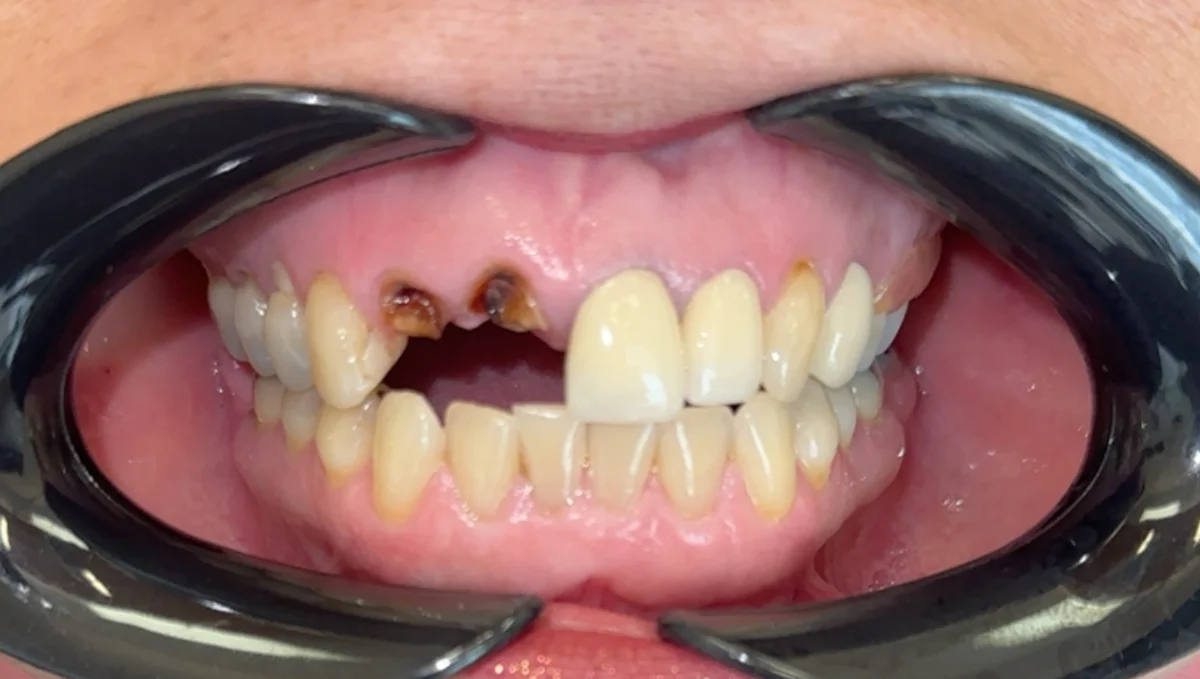 Before — real smile transformation at Lava Dental