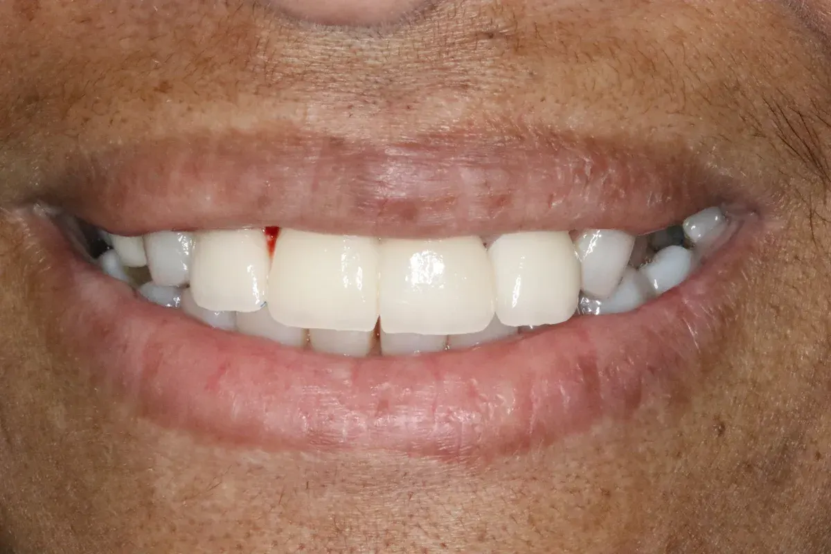 After — real smile transformation at Lava Dental