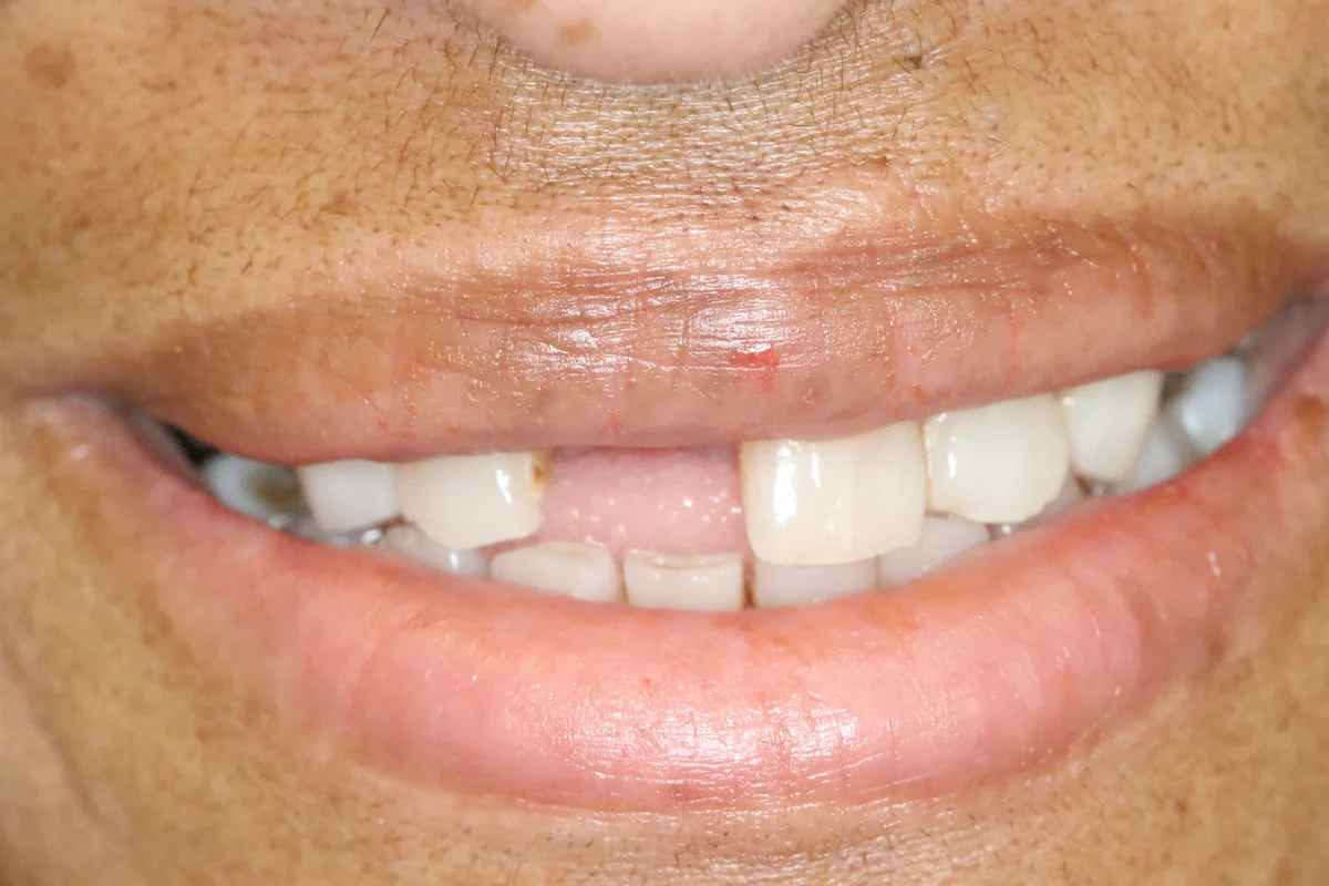 Before — real smile transformation at Lava Dental