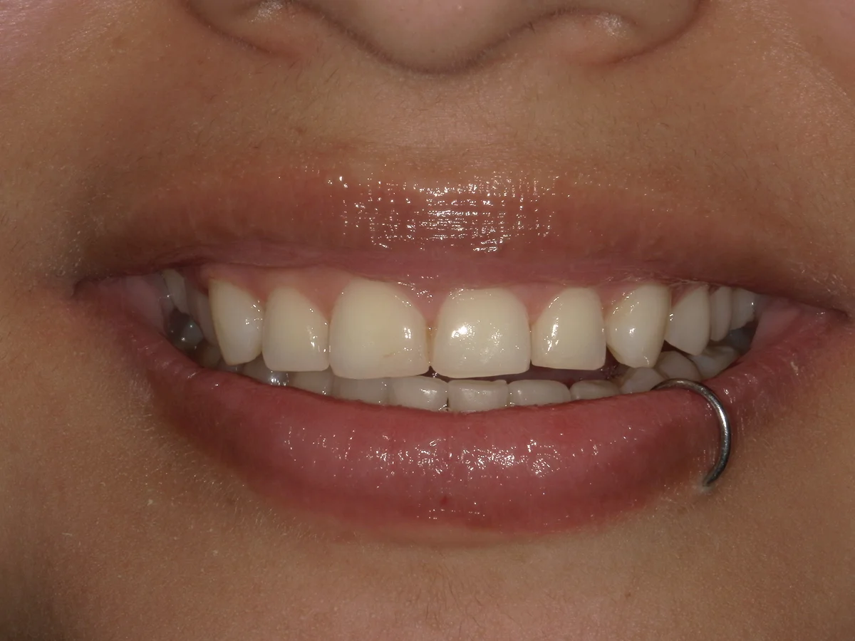 After — real smile transformation at Lava Dental
