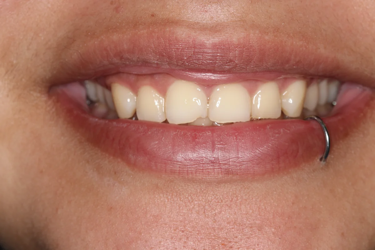Before — real smile transformation at Lava Dental