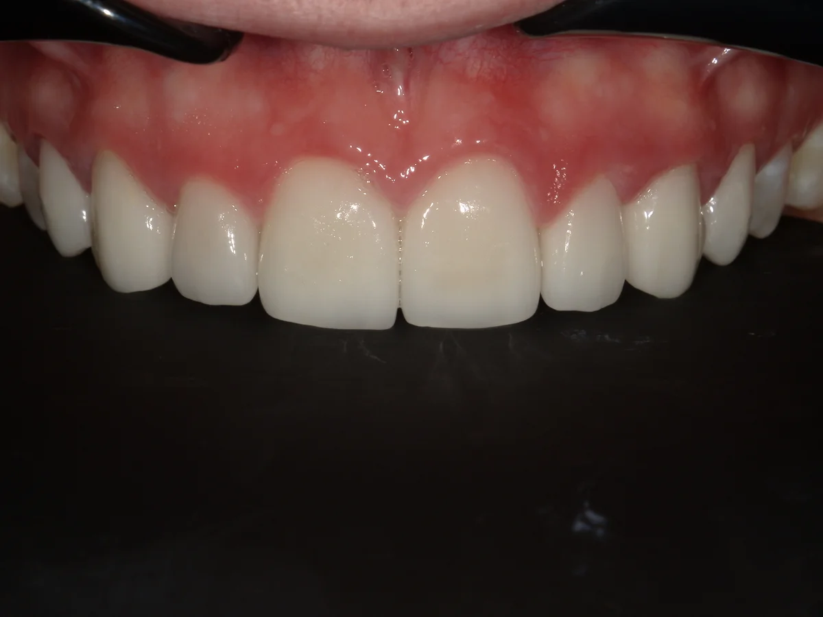 After — real smile transformation at Lava Dental