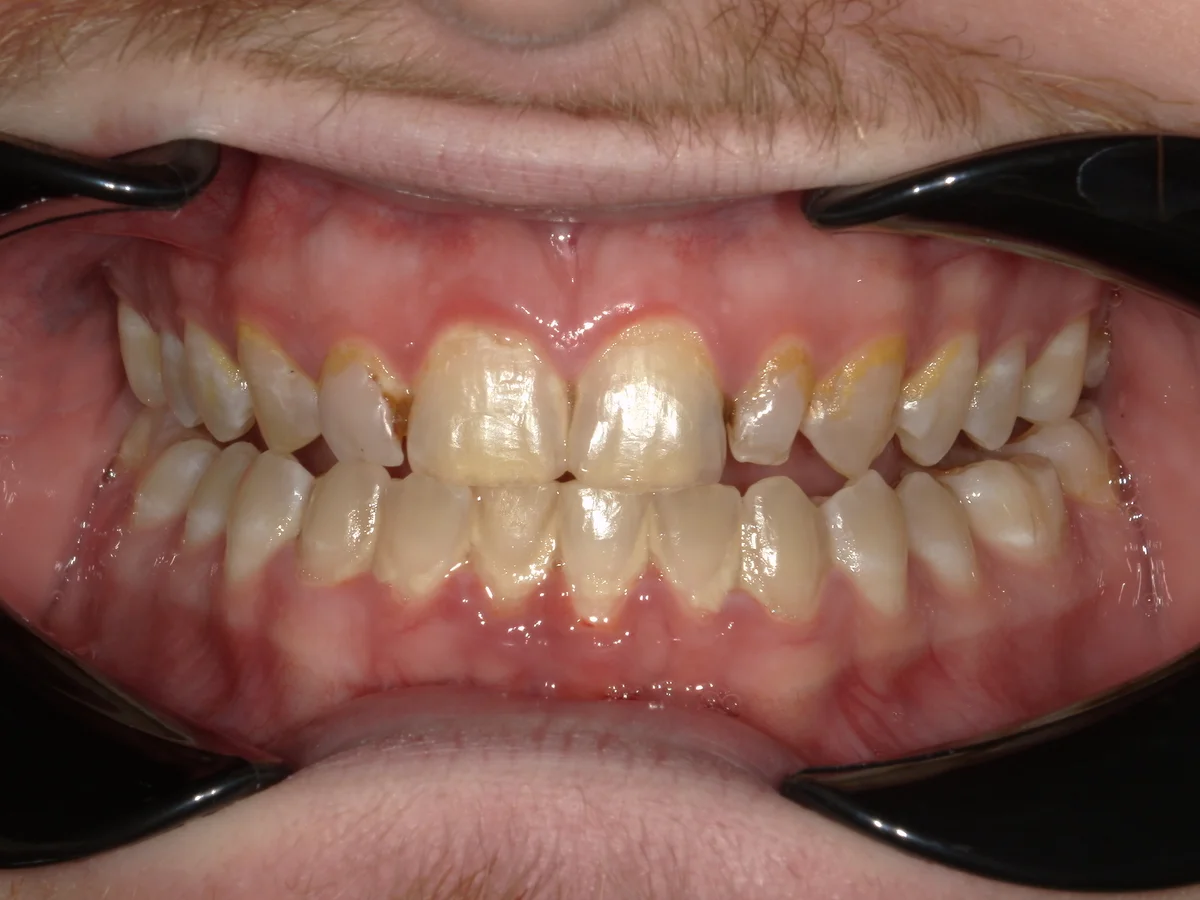 Before — real smile transformation at Lava Dental