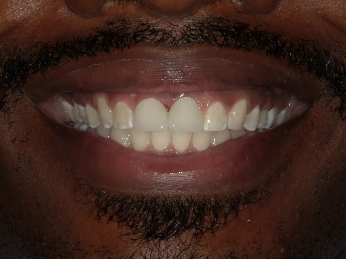 After — real smile transformation at Lava Dental