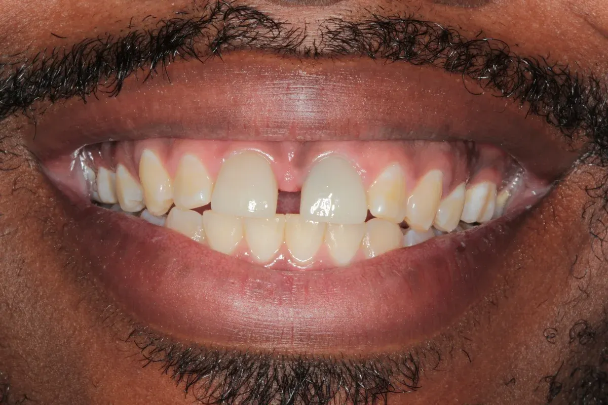 Before — real smile transformation at Lava Dental