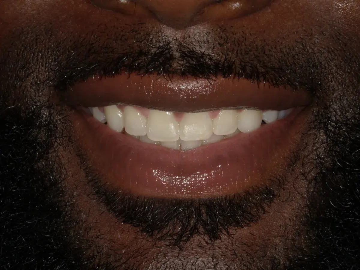 After — real smile transformation at Lava Dental